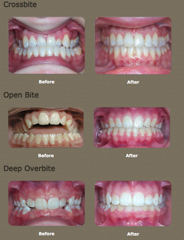 crossbite braces before after