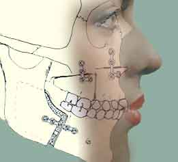 Orthognathic Surgery